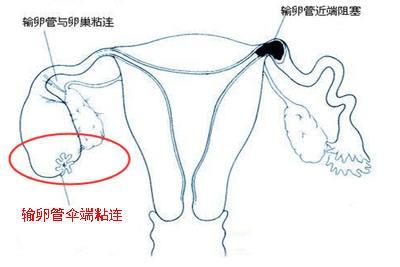 输卵管粘连是什么原因引起的呢,输卵管切除术后粘连有哪些症状