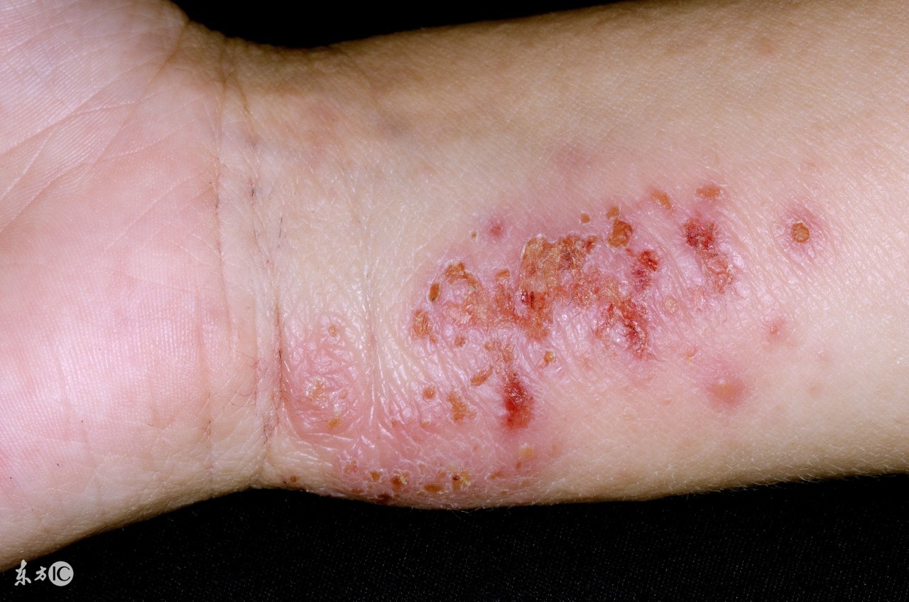 关注银翘病咨询,关注皮肤病