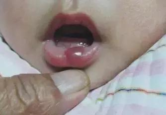 口水多和脑血管有关系吗,嘴巴上血管瘤会影响身体吗