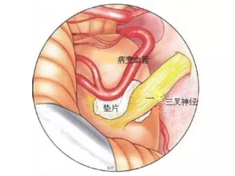 手术天下第一疼是什么手术,天下第一痛三叉神经痛到底有多痛