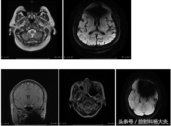 有假牙头部做磁共振有影响吗,有假牙能做核磁共振全过程视频