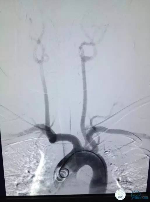 急性缺血性卒中静脉溶栓2018指南,急性缺血性卒中血管内再通标准