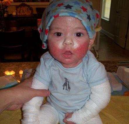 宝宝肤专家可以治疗湿疹吗,一岁半宝宝湿疹怎么治疗