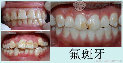 氟斑牙是什么意思,氟斑牙用什么牌子牙膏