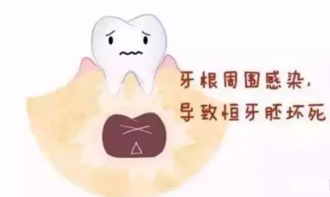 宝宝乳牙龋齿严重用拔牙不,孩子乳牙龋齿有必要补牙吗