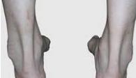 x型腿该如何改善o型腿,o型腿矫正纯干货分享