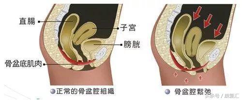 盆底肌正确康复方法,一文读懂心肺复苏