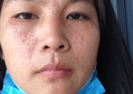 激素脸治疗恢复时间要多久？治疗激素脸的时间一般是多久？