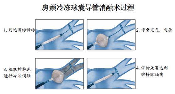 心脏房颤治疗需要多少钱,电复律治疗房颤对心脏有损害吗