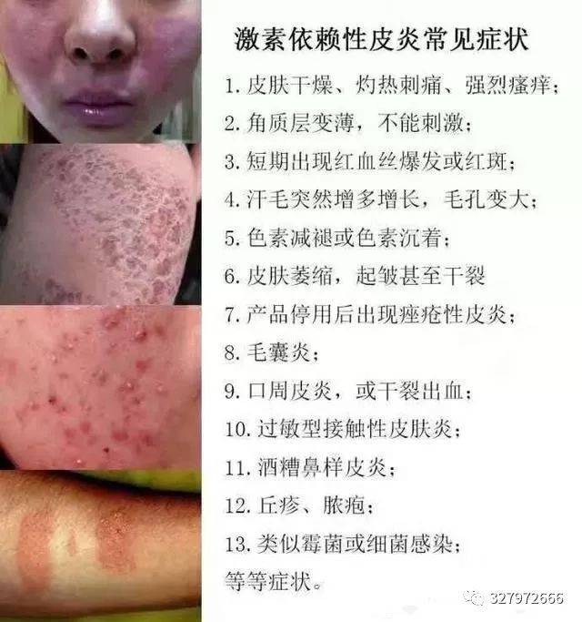 激素脸发红发烫怎么能快速修复好,激素脸灼热要怎么治疗