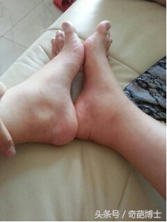 孕期水肿太厉害了怎么办,孕期水肿有什么缓解方法