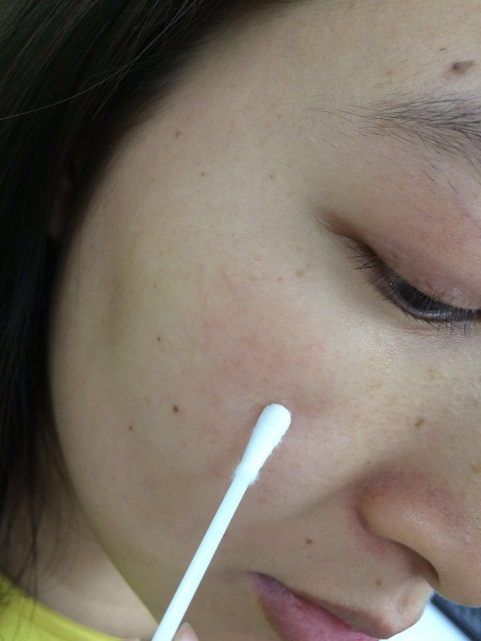 健康关注重点,哪些位置的痘不能随便乱挤