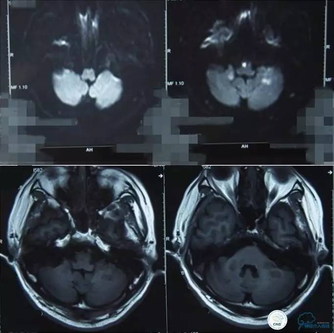 急性缺血性卒中静脉溶栓2018指南,急性缺血性卒中血管内再通标准