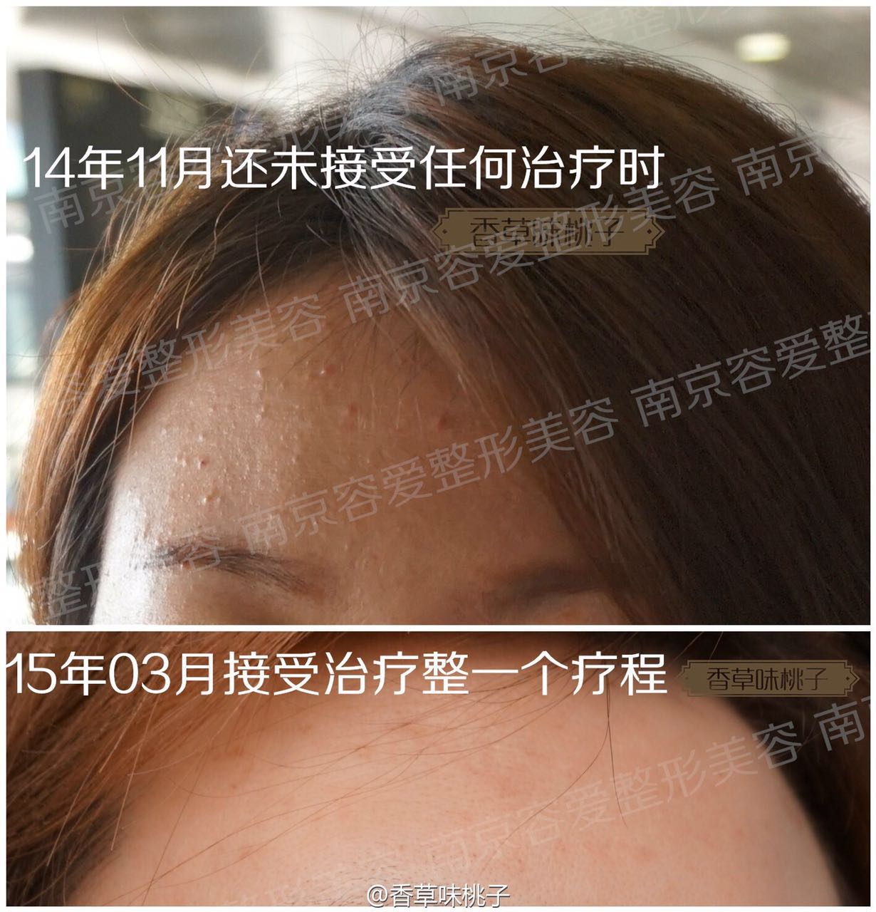 手把手教你如何抗痘,教你有效抗痘6个绝招