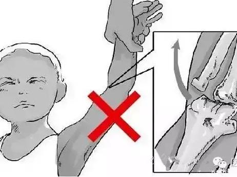 幼儿胳膊脱臼治疗方法,小孩胳膊脱臼复位教程