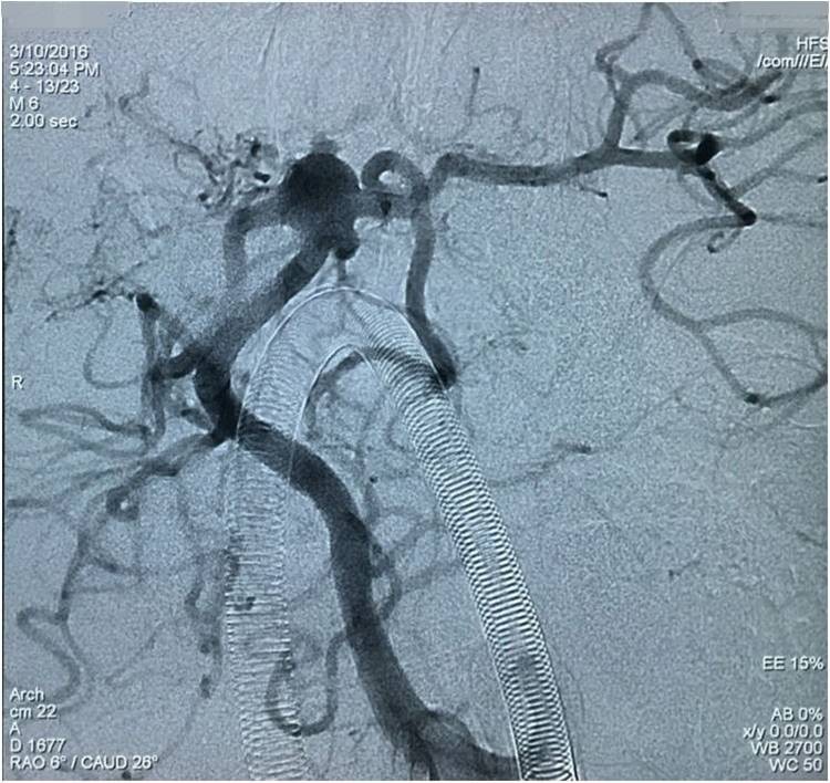 基底动脉顶端动脉瘤加左侧小脑上动脉瘤以Y型支架结合弹簧圈栓塞