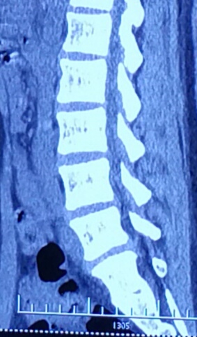 美女们的腰椎间盘突出这么多?