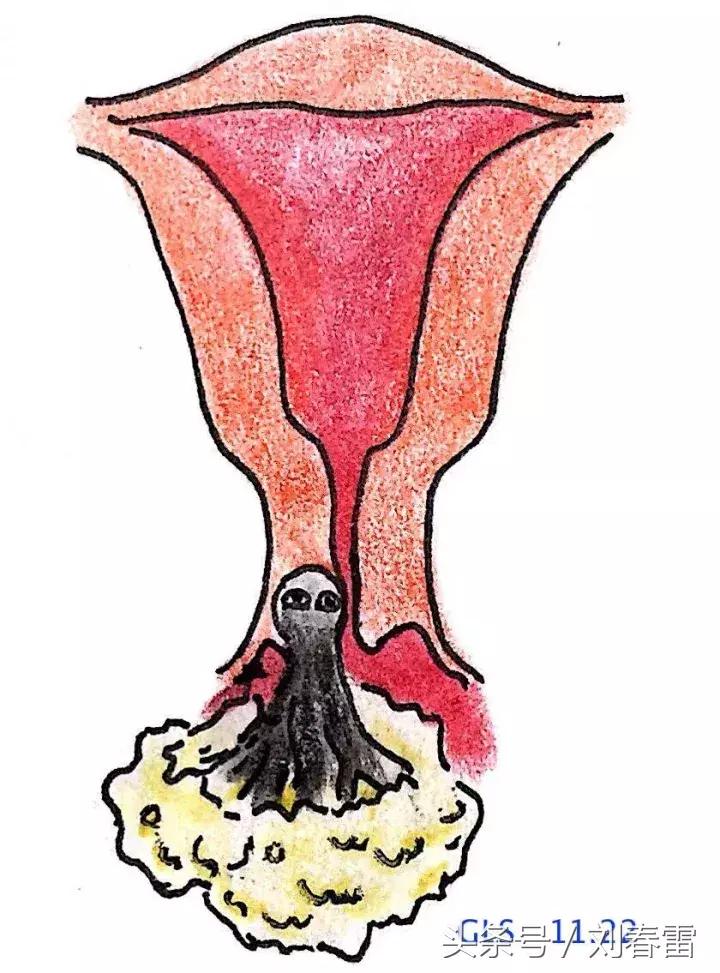 宫颈癌科普知识宣教视频,宫颈癌的科普知识宣传