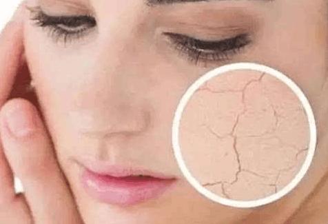 脸上皮肤经常过敏是激素脸吗?怎样才能知道自己是不是激素脸