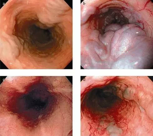 肝硬化晚期的4种并发症要警惕,肝硬化吐血发病前怎么预防