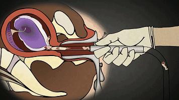 打胎有啥大不了，无痛人流！自宫还能成就东方不败！你要挥刀吗？