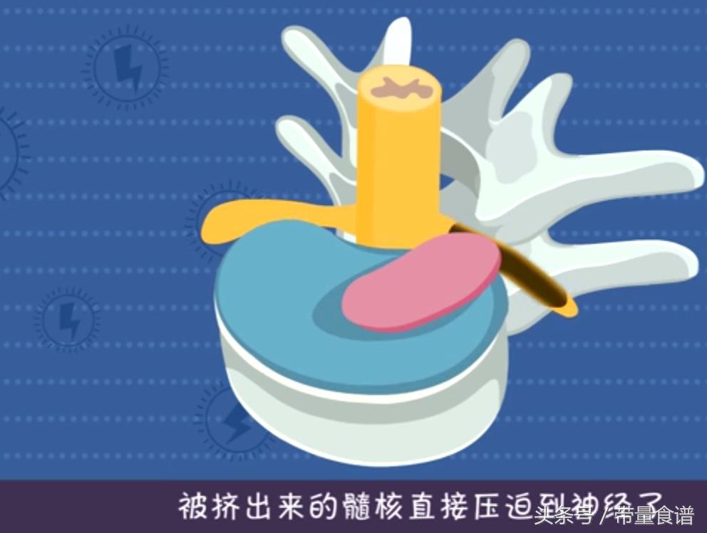 坐不久就腰痛怎么回事,坐着的时候腰椎间盘突出