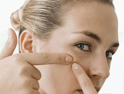 痘痘皮肤怎么护理简单方法,痘痘皮肤如何护肤