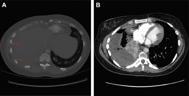 病例讨论:宫颈癌患者为何出现呼吸急促和胸痛?