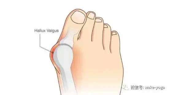 脚趾外翻的真正原因,大脚趾外翻越来越严重