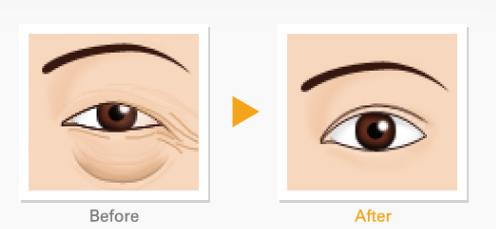 眼袋手术彻底去眼袋,去眼袋手术改善眼角纹吗