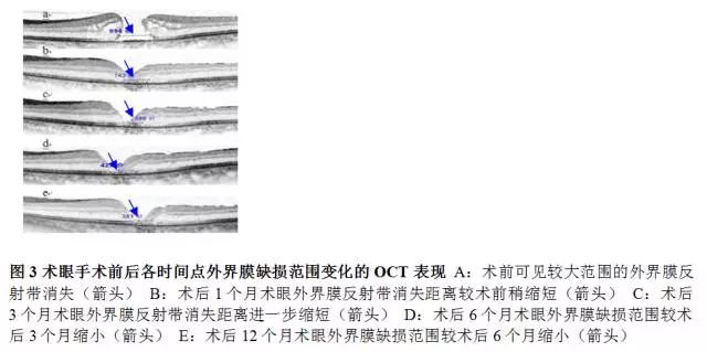 玻璃体移植,玻璃体切除联合手术