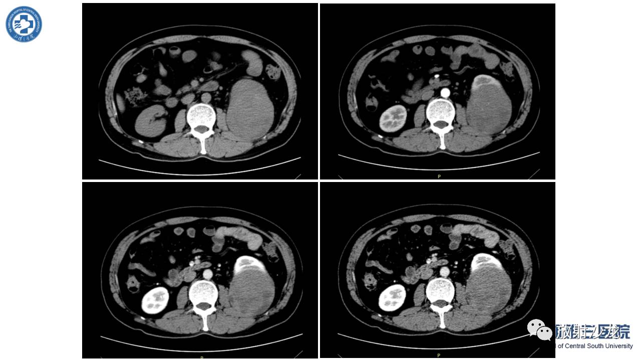 左腰侧边撞伤里面隐隐作痛,左腰被撞现在肚子痛