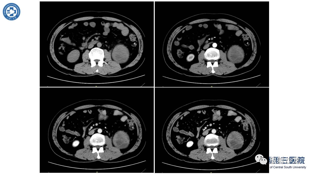 左腰侧边撞伤里面隐隐作痛,左腰被撞现在肚子痛