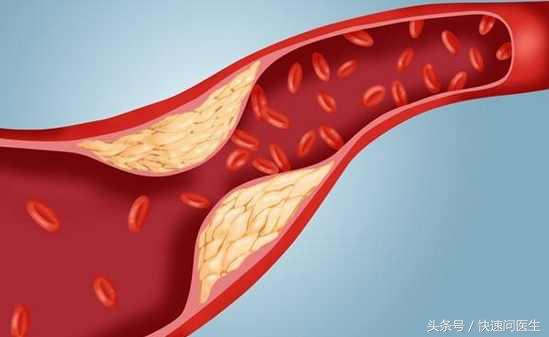 动脉血栓会引起大腿肌肉疼吗,动脉血栓的并发症有哪些