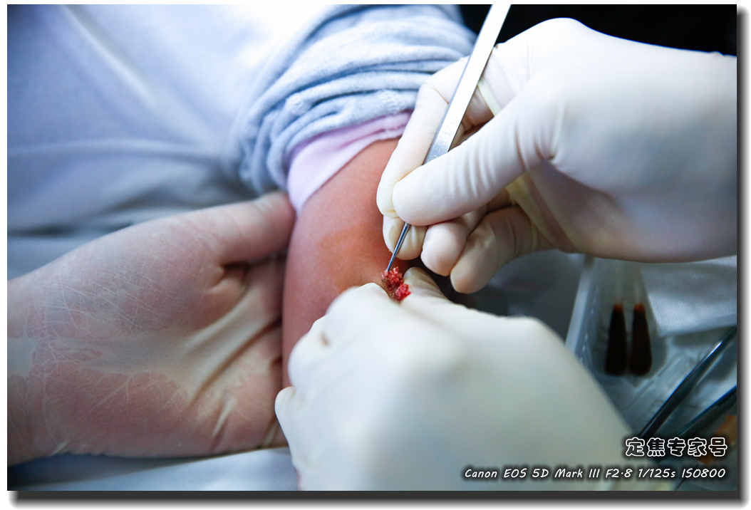 皮肤专家诊室故事连载之四，胳膊上一个小硬块能掏出多少东西？