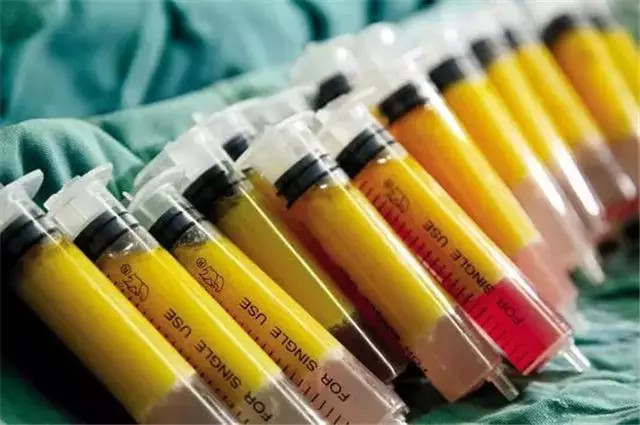 自体脂肪填充肋骨,自体脂肪填充有几种方式