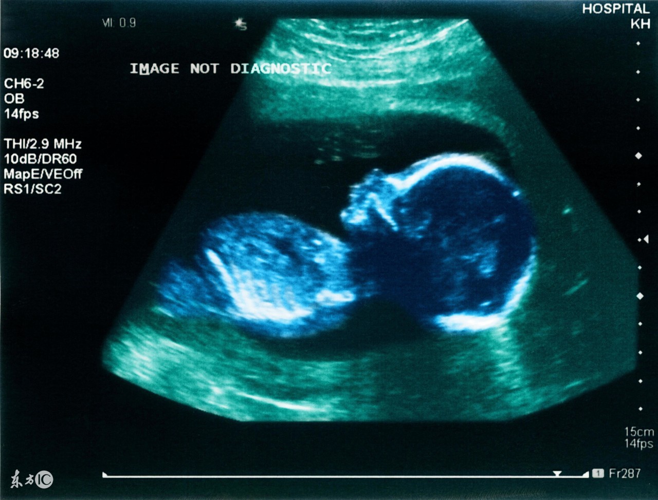 产前诊断孕前一周b超是什么,b超二级产前筛查