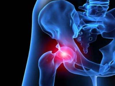 股骨头坏死，用药为何要讲“疗程”？