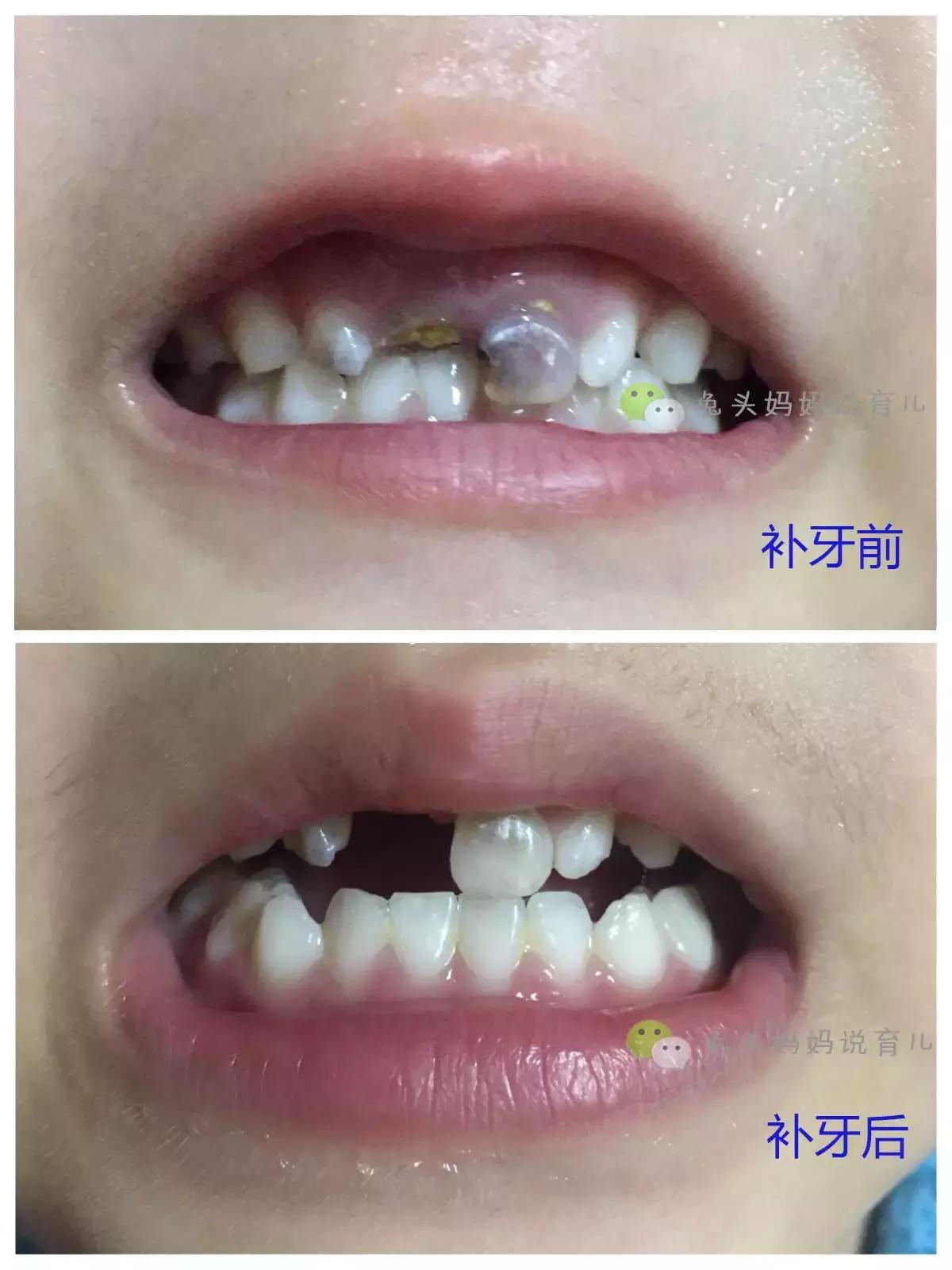 带娃看牙医,带孩子看牙医拍片不给片子