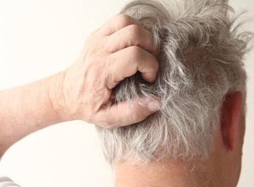 脂溢性皮炎皮肤红彤彤的怎么治,脂溢性皮炎又红又痒