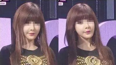 自体脂肪填充会下垂和移位吗,自体脂肪填充脸部后会自己消失吗