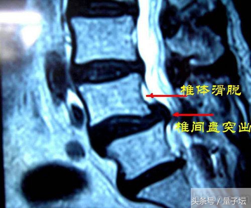 腰椎间盘突出放射到脚,放射科可以检查腰椎间盘突出吗