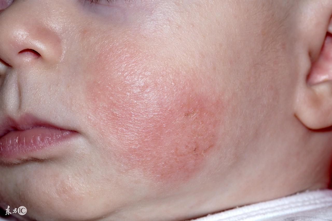 婴幼儿湿疹大作战！各种宝宝湿疹药膏面霜测评！（宝妈亲测有效）