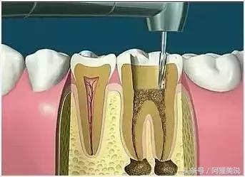 根管治疗最后补牙单独收费的吗,根管治疗最后一步需要多少钱