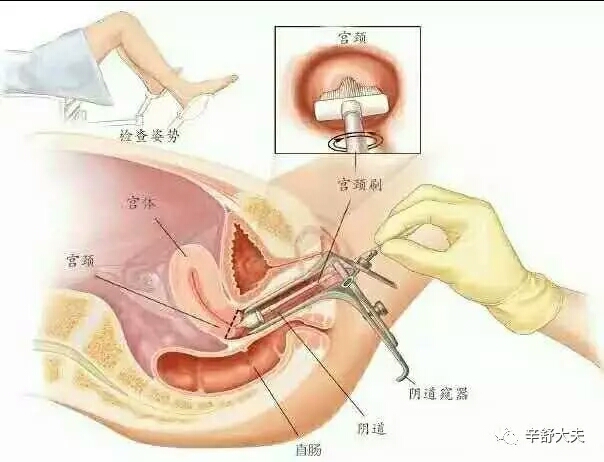 hpv26型号阳性怎么办,Hpv阳性怎么办