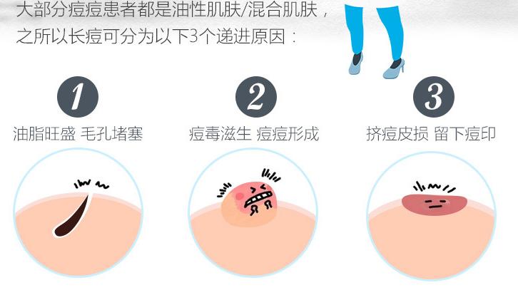 真正有效的祛痘方式,真正能祛痘的偏方