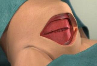 剖腹产竖切刀口比横切刀口恢复慢,产前一定要知道什么