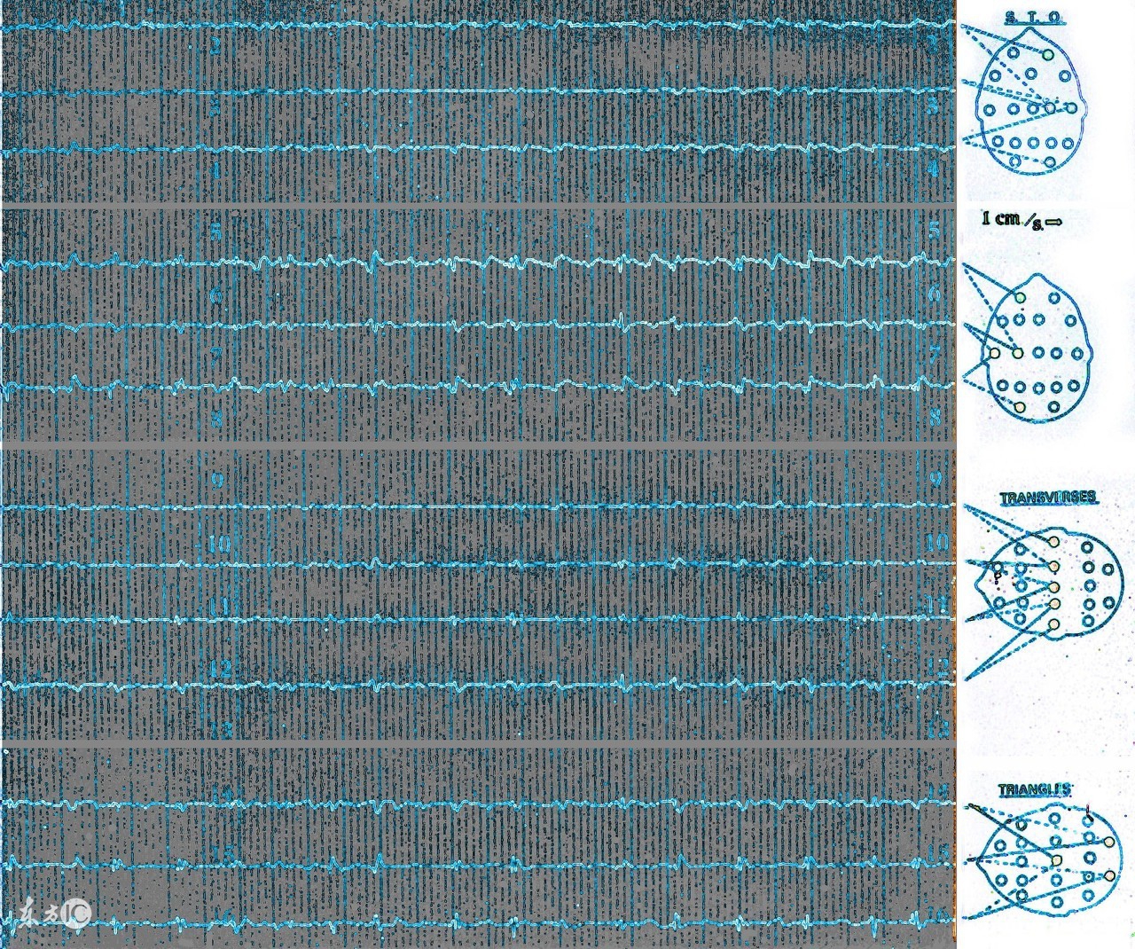 全面性癫痫发作和局灶性癫痫区别,1岁左右癫痫发作会是良性癫痫吗
