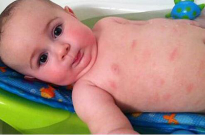 引起宝宝湿疹的原因和解决方案,宝宝容易长湿疹妈妈应该注意什么