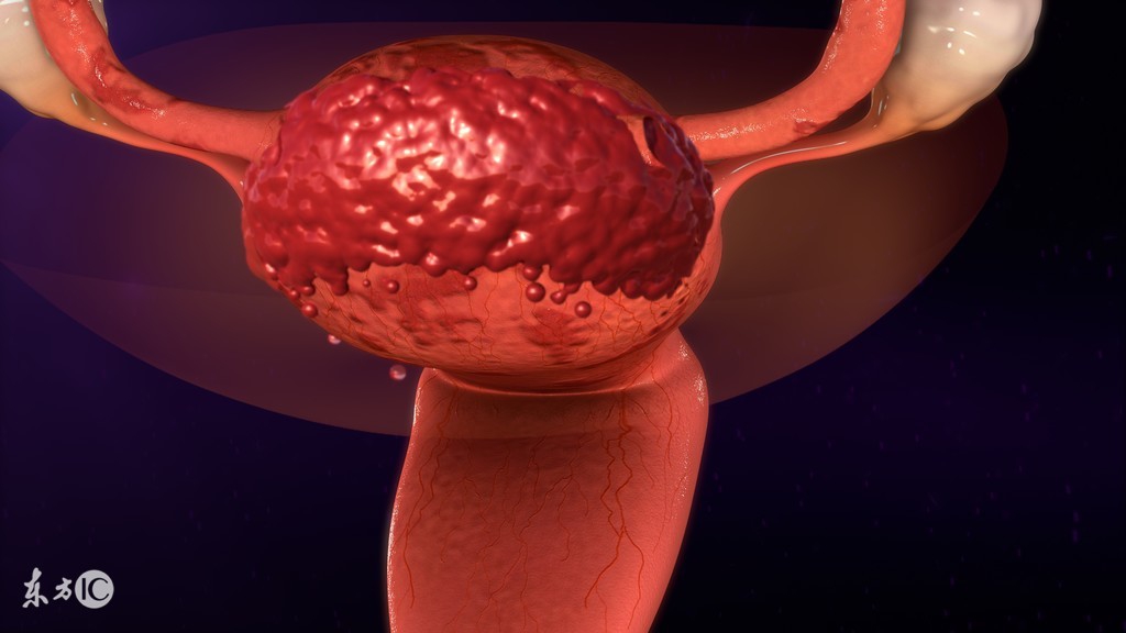 子宫内膜增厚刮宫后注意事项,内膜增厚宫腔镜刮宫后注意事项